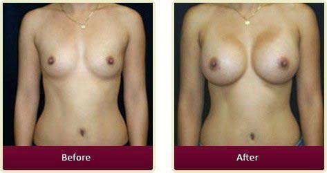 Plastic Surgeon Huntington Beach - Breast Before After 