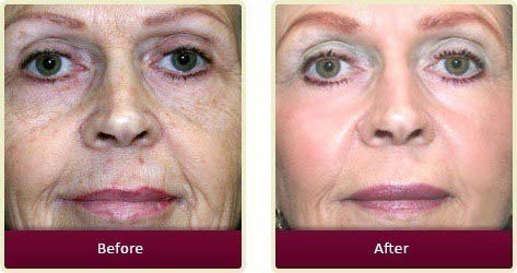 Plastic Surgeon Huntington Beach - Face Before After