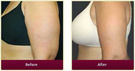 Plastic Surgeon Huntington Beach - Body Contouring Before After