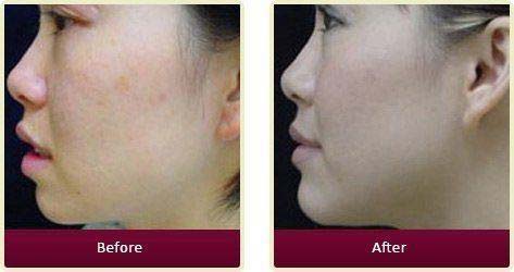 Plastic Surgeon Huntington Beach - Asian Face Before After