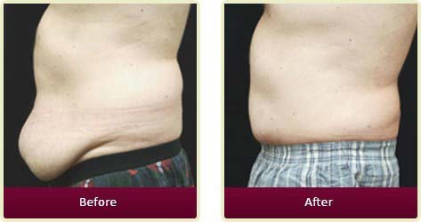 Plastic Surgeon Huntington Beach - Cosmetic Surgery for Men Before After