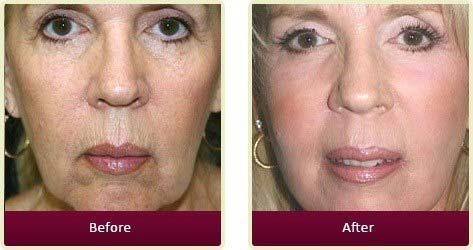 Plastic Surgeon Huntington Beach - Before After Medspa